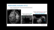 Invasive Lobular Carcinoma Multimodality Primer
