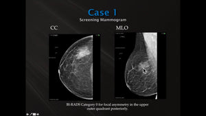 Case Reviews: Finding Breast Cancer with 3D Breast Tomosynthesis - Efficiency Learning Systems
