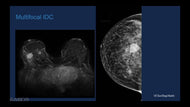 Breast MRI: Full, Abbreviated, and Ultrafast