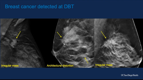 Diagnostic Breast Imaging and Interventions in the age of Digital Breast Tomosynthesis