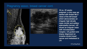 Breast Cancer in Young Women (Under the Age of Forty)
