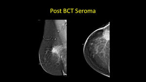 High Risk Surveillance – Mammographic and MRI Surveillance after Breast Cancer