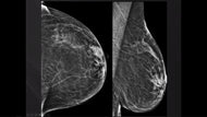 Tomosynthesis (3D) Breast Biopsy