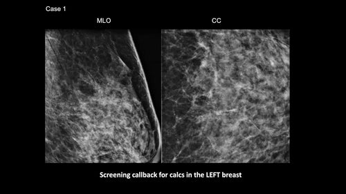 Cracking the Case: Challenging Calcifications
