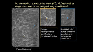 Cracking the Case: Challenging Calcifications