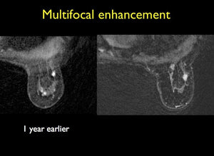 Breast MRI: Quick and Easy - Efficiency Learning Systems