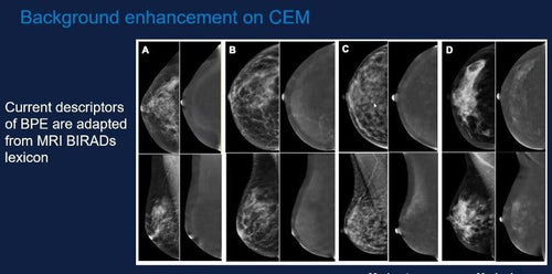 Contrast Enhanced Mammography: Techniques and Indication - Efficiency Learning Systems