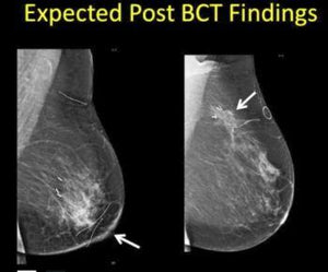 High Risk Surveillance – Mammographic and MRI Surveillance after Breast Cancer - Efficiency Learning Systems