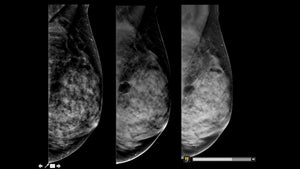 Breast Imaging CME: Hot Topics I
