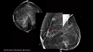 Breast Imaging CME: Hot Topics I