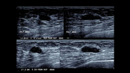Breast Ultrasound with Dr. Gundry