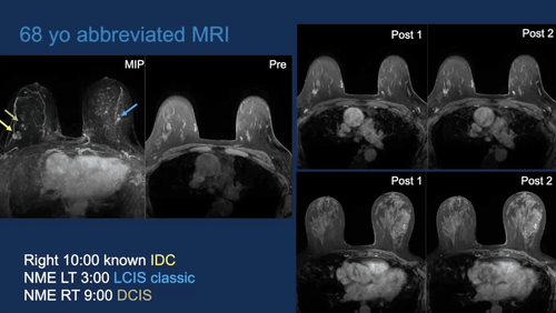 Breast MRI : Comprehensive 2nd Edition - Efficiency Learning Systems