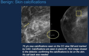 Calcifications on Digital Breast Tomosynthesis: Challenges and Advantages of Implementing Synthesized View - Efficiency Learning Systems