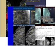 Combine Topics: Breast Tomosynthesis 2020 & Breast Imaging CME: Hot Topics - Efficiency Learning Systems