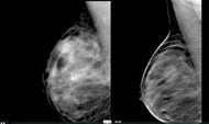Digital Breast Tomosynthesis: A Better Mammogram - Efficiency Learning Systems