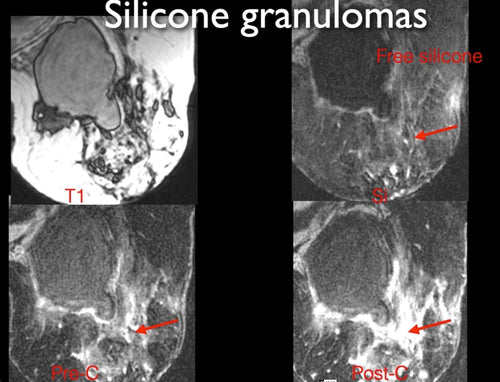 MRI of Women with Silicone Augmentation - Efficiency Learning Systems