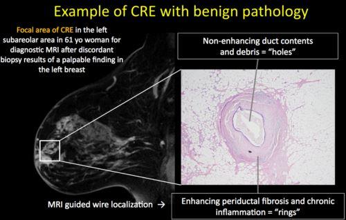 Spectrum of Clustered Ring Enhancement (CRE) on Breast MRI: Malignancies and their Mimics - Efficiency Learning Systems